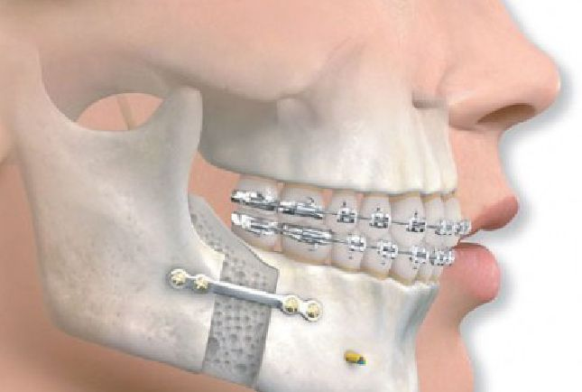 orthognathiki_xeirourgiki_orthognathic_surgery_mt_orthodontics.jpg