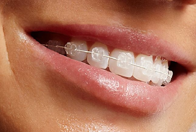transparent_braces_diafani_siderakia_panagiota_magkavali_trikka_dental_care.jpg
